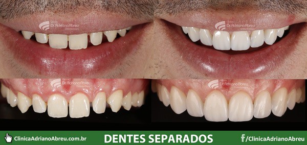 dentes-separados