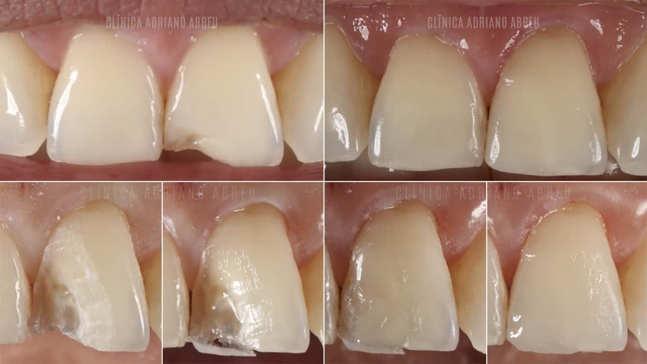 Como é o tratamento de dentes quebrados com resina? Veja algumas etapas.