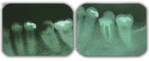 Raio-x de paciente com lesões de cárie e sintomas de dor e sinais clínicos para indicação de endodontia