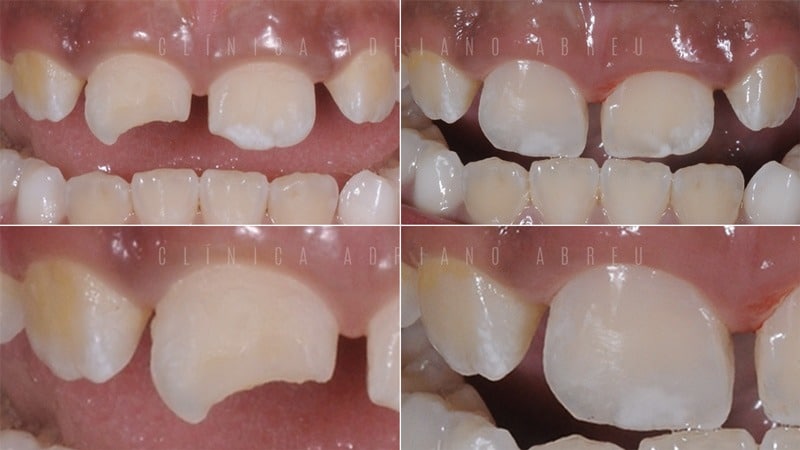 Tratamento de Dentes Quebrados com Resina em Crianças