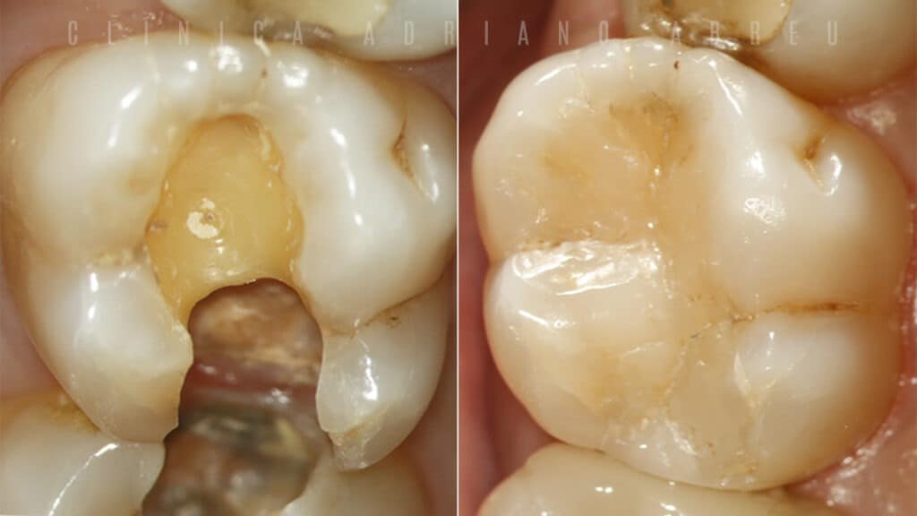 Restauração de dente com cárie