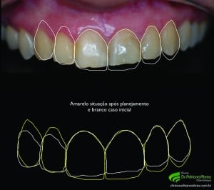 Imagem do Planejamento Digital Estético mostrando o comparativo entre o inicio do caso e o futuro sorriso