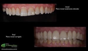 Imagem do Planejamento Digital Estético, mostrando o alinhamento dos dentes