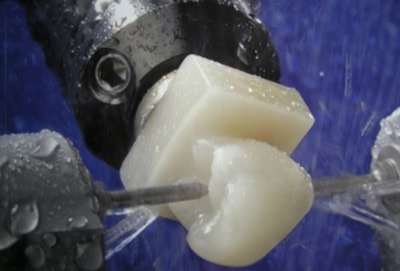 Dente artificial sendo confeccionado pelo CEREC