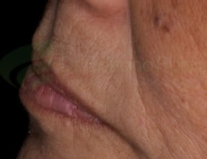 Região acima do lábio pode denunciar a presença da prótese 