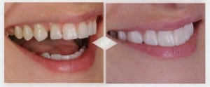 Pessoas com dentes separados, muito curtos quebrados ou amarelados podem usar o o mockup para ver o futuro resultado em sua própria boca
