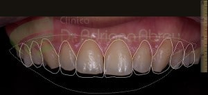 Planejamento Digital Estético de uma faceta lente de contato