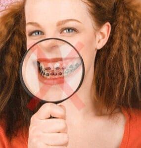 A ortodontia lingual é ideal para quem não quer exibir o famoso sorriso metálico