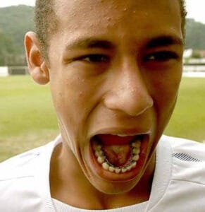 Sua função é idêntica a de um aparelho comum, porém, fica escondido atrás nos dentes. O caso do jogador Neymar é um bom exemplo
