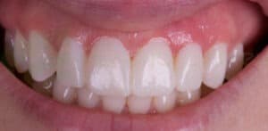 Divisões da odontologia estética: A estética branca cuida dos dentes e a rosa trata das gengivas.
