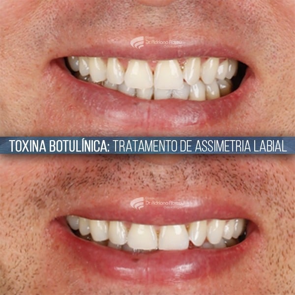Sorriso assimétrico: Estudo de caso de tratamento de assimetria labial com toxina botulínica na odontologia.