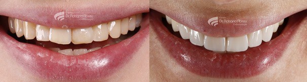 Além de dentes bonitos, um bom trabalho de odontologia estética, precisa de resultado natural
