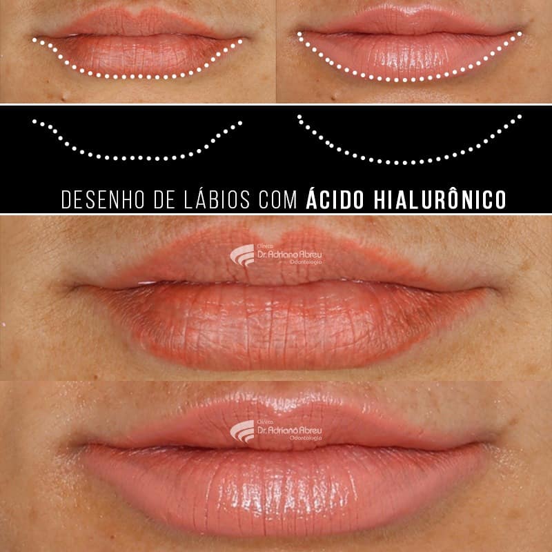 Design de Lábios com Preenchimento Facial com Ácido Hialurônico