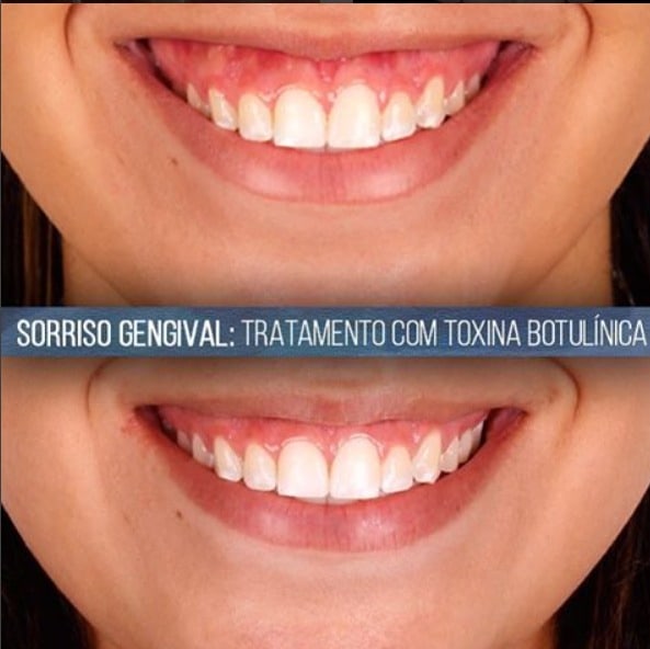 Sorriso gengival: é regra na odontologia estética que a pessoa mostre entre 2 ou 3 milímetros de gengiva