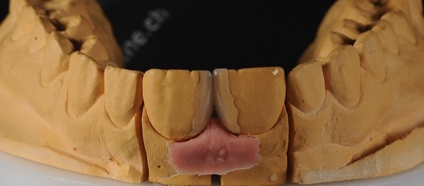 Fragmentos são indicados para poucos dentes