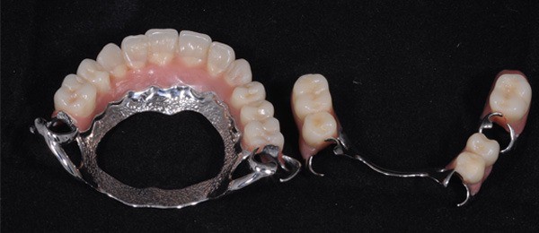 a-protese-parcial-removivel-e-sustentada-pelos-dentes-naturais